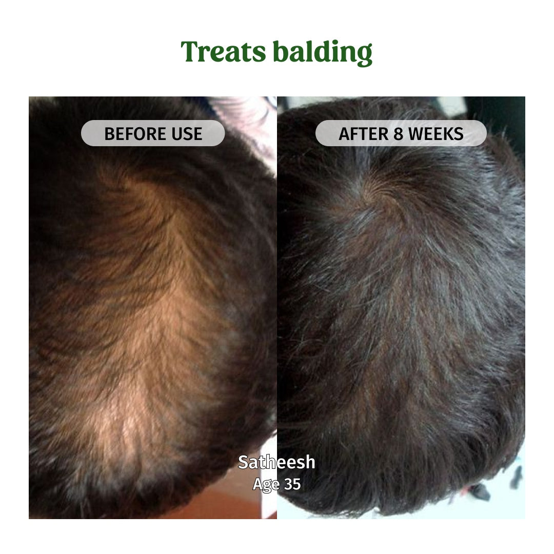 Hair Regrowth Oil